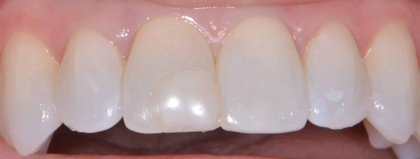 Front Tooth Filling Case Study | Leavitt Dentistry